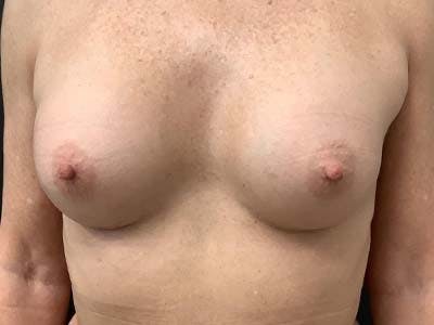 Breast Augmentation Gallery - Patient 122008189 - Image 2