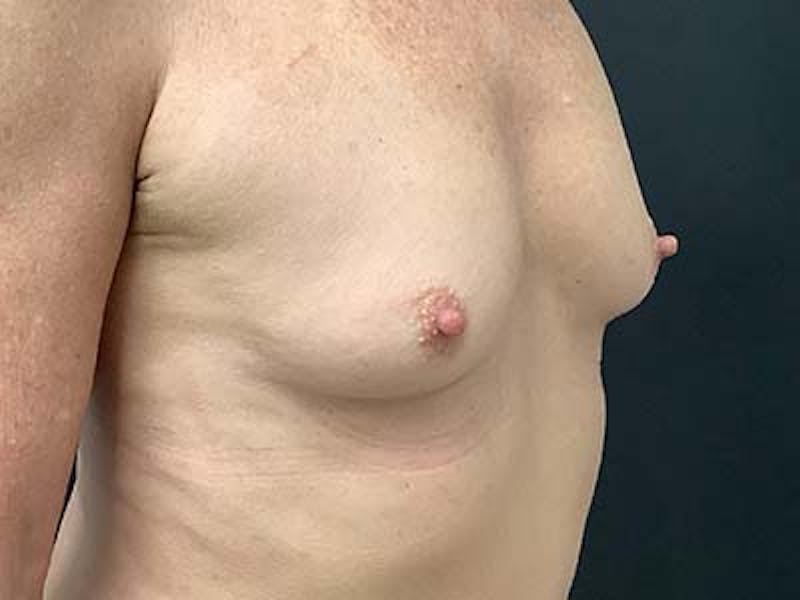 Breast Augmentation Before & After Gallery - Patient 122008189 - Image 3