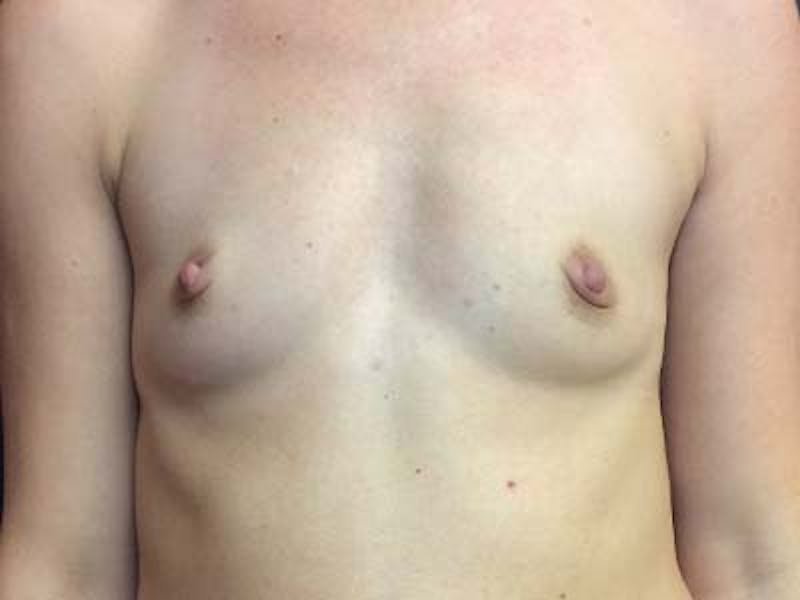 Breast Augmentation Before & After Gallery - Patient 122008187 - Image 1