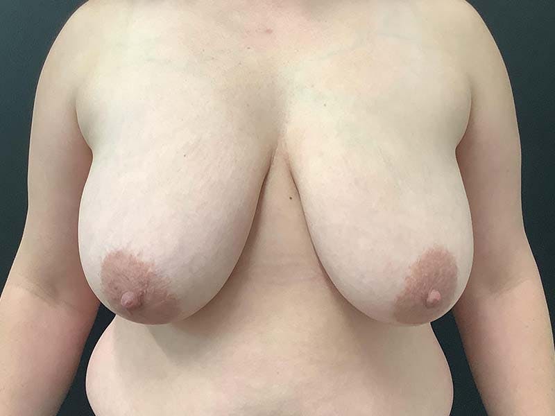 Breast Lift Before & After Gallery - Patient 122054786 - Image 1