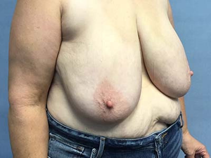 Breast Reduction Before & After Gallery - Patient 122054839 - Image 3