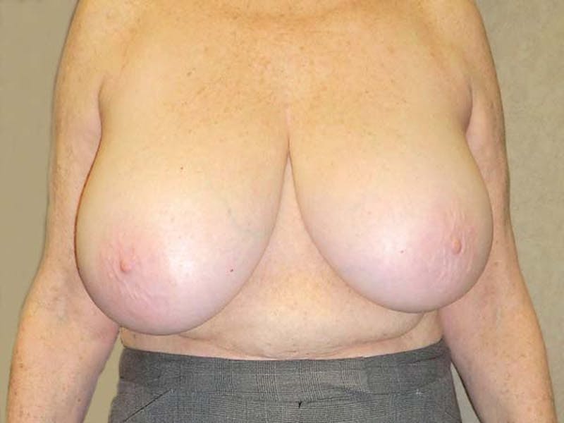 Breast Reduction Before & After Gallery - Patient 122075574 - Image 1