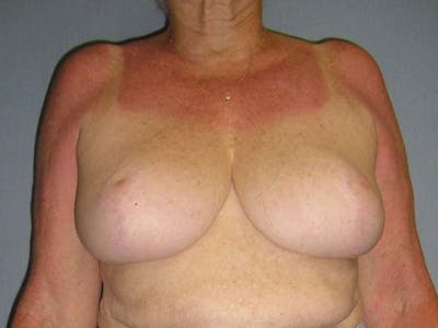 Breast Reduction Before & After Gallery - Patient 122075574 - Image 2