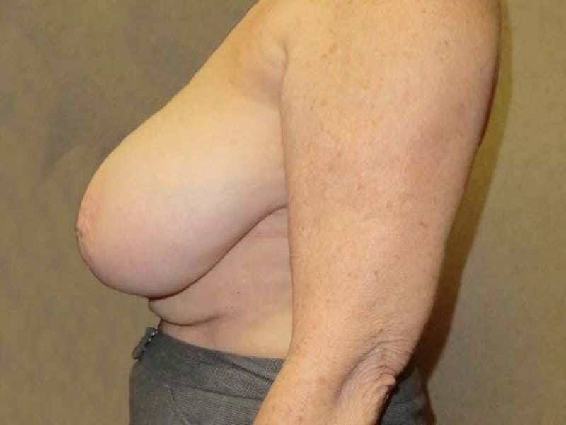 Breast Reduction Before & After Gallery - Patient 122075574 - Image 3