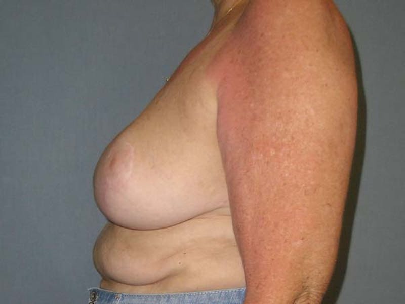 Breast Reduction Before & After Gallery - Patient 122075574 - Image 4