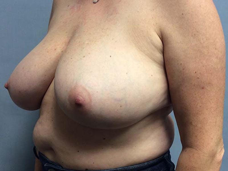 Breast Reduction Before & After Gallery - Patient 122075639 - Image 3