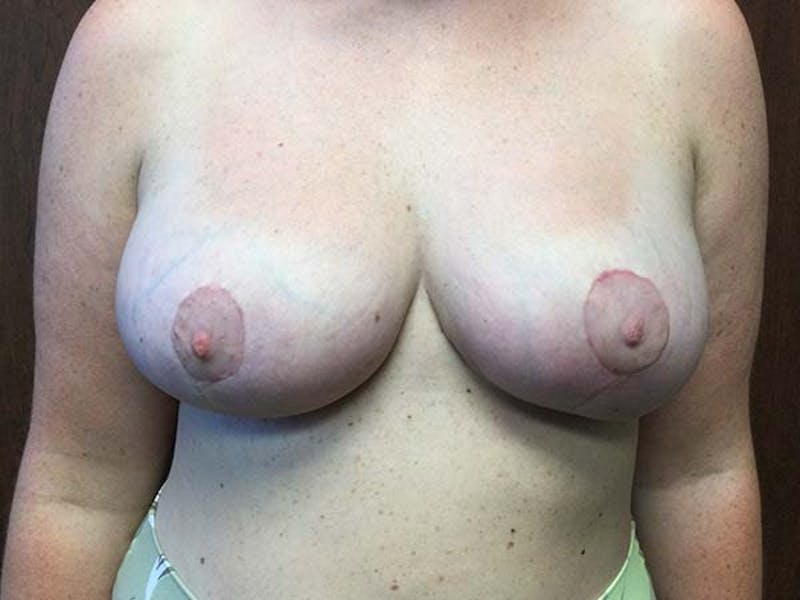 Breast Reduction Before & After Gallery - Patient 122075636 - Image 2