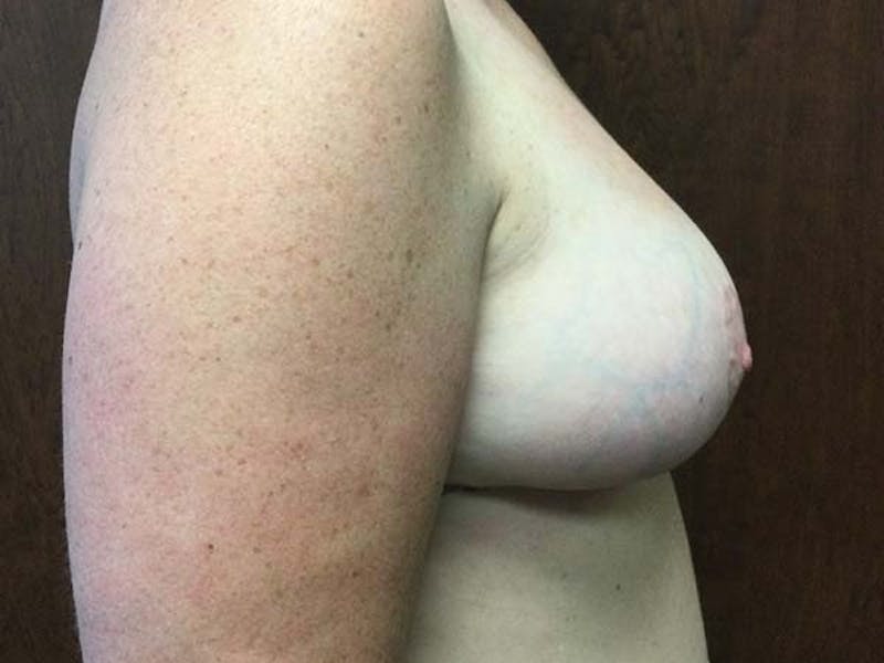 Breast Reduction Before & After Gallery - Patient 122075636 - Image 4