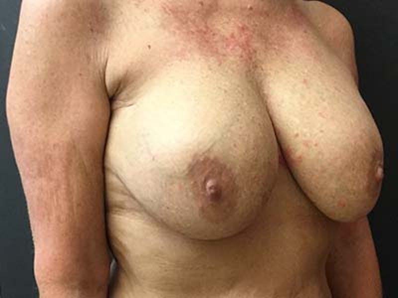 Breast Revision Before & After Gallery - Patient 122075855 - Image 3