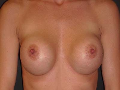 Breast Revision