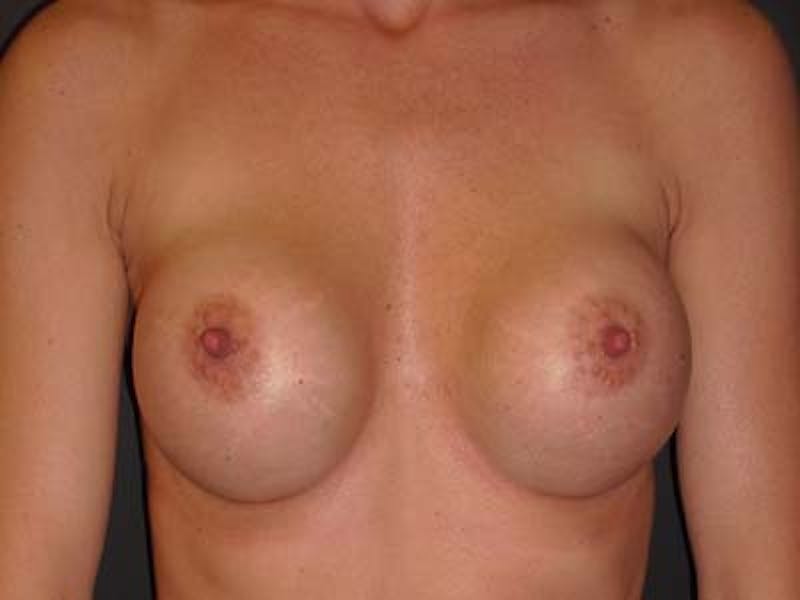 Breast Revision Before & After Gallery - Patient 122075856 - Image 1