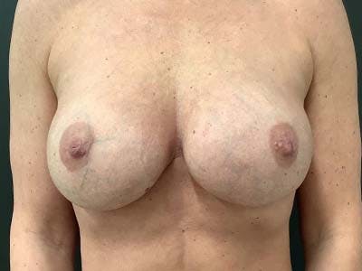 Breast Revision Before & After Gallery - Patient 122075857 - Image 2
