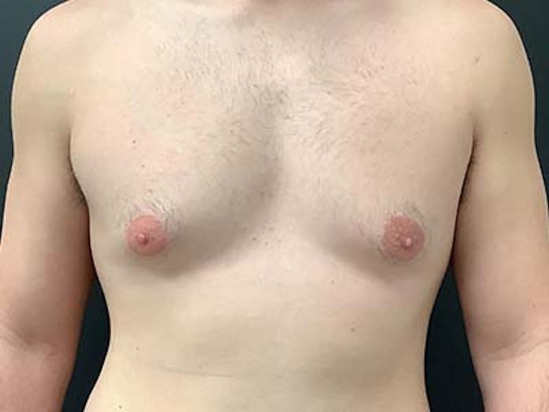 Gynecomastia Before & After Gallery - Patient 122076149 - Image 1