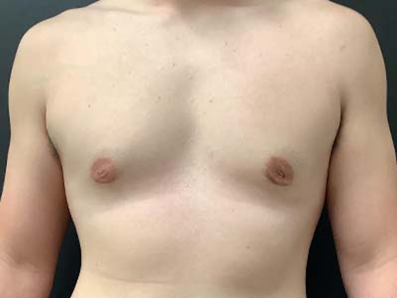 Gynecomastia Before & After Gallery - Patient 122076149 - Image 2