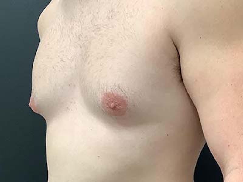 Gynecomastia Before & After Gallery - Patient 122076149 - Image 3