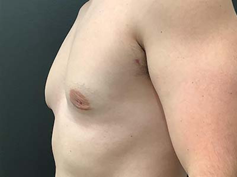 Gynecomastia Before & After Gallery - Patient 122076149 - Image 4