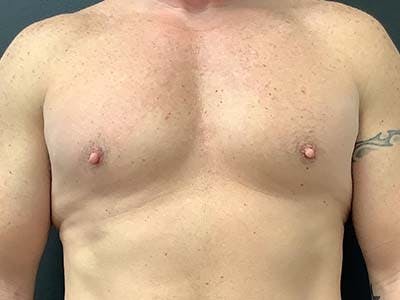 Gynecomastia Before & After Gallery - Patient 122076150 - Image 1