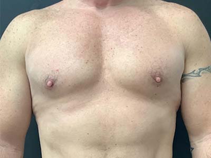 Gynecomastia Before & After Gallery - Patient 122076150 - Image 2