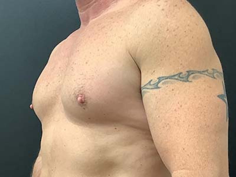 Gynecomastia Before & After Gallery - Patient 122076150 - Image 3