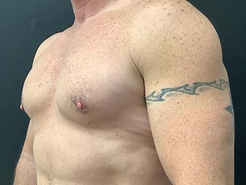 Gynecomastia Before & After Gallery - Patient 122076150 - Image 4
