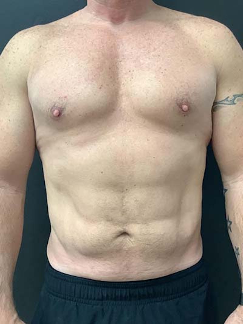 Liposuction Before & After Gallery - Patient 122076264 - Image 2