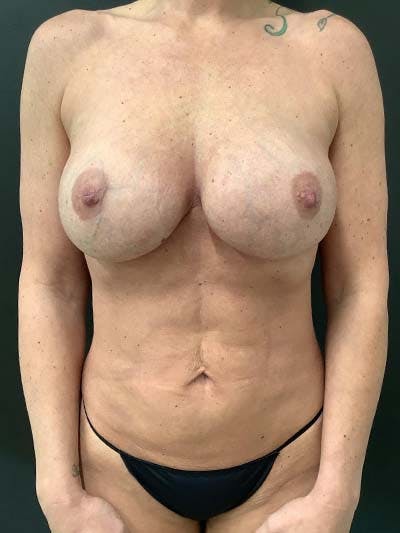 Liposuction Before & After Gallery - Patient 122076265 - Image 2