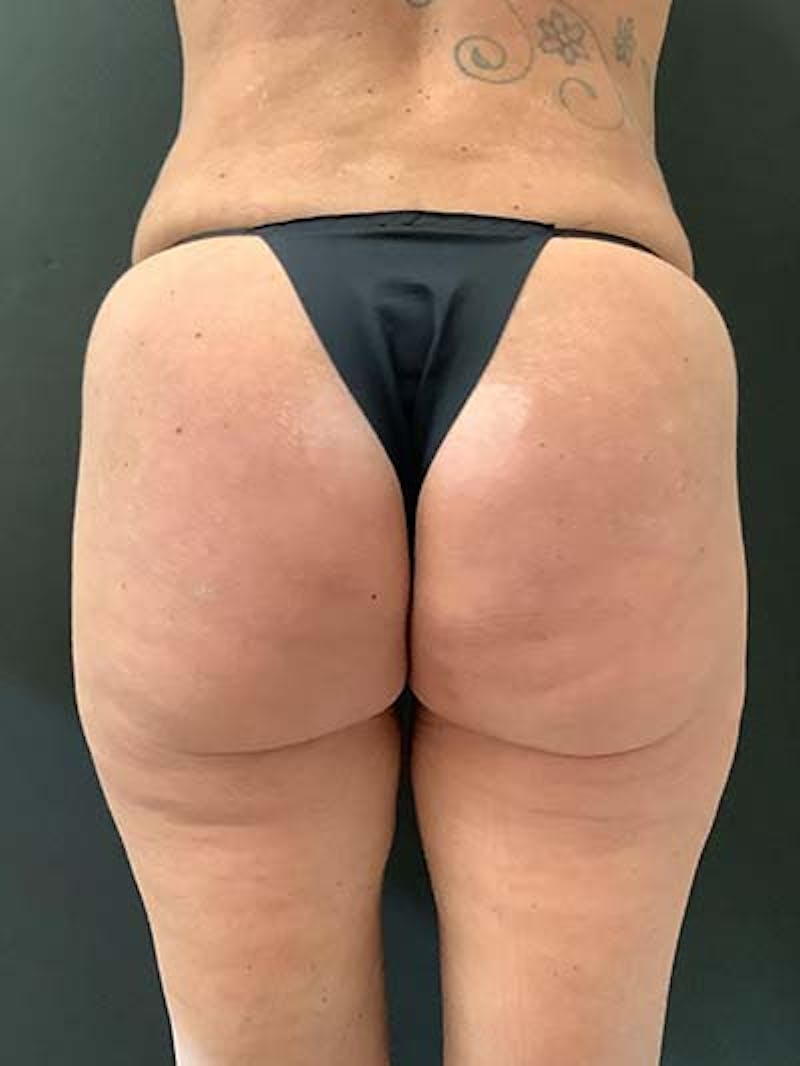Liposuction Before & After Gallery - Patient 122076265 - Image 3