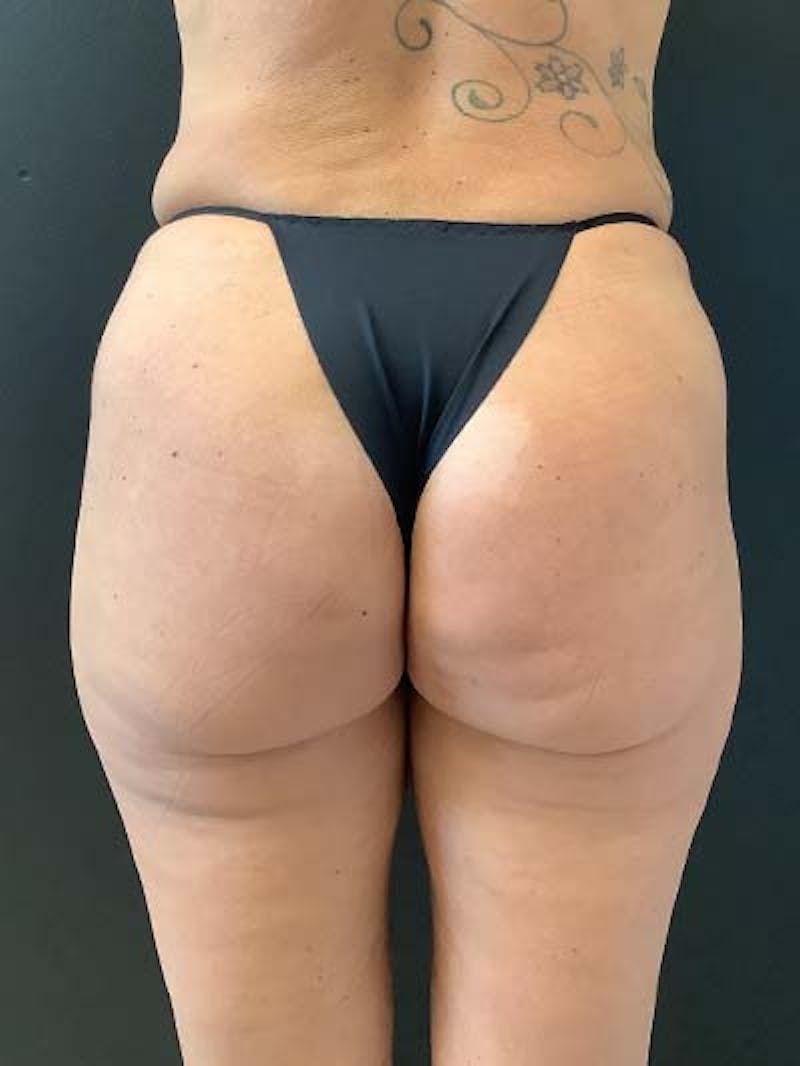 Liposuction Before & After Gallery - Patient 122076265 - Image 4