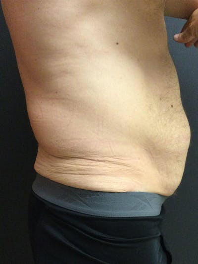 Abdominoplasty Before & After Gallery - Patient 123700533 - Image 1