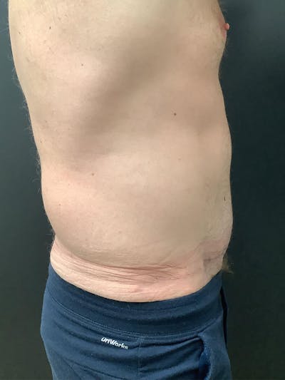 Abdominoplasty Before & After Gallery - Patient 123700533 - Image 2
