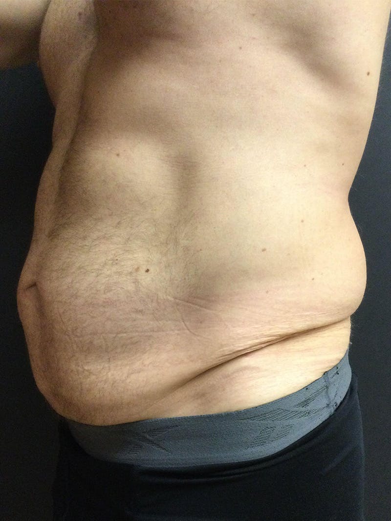 Abdominoplasty Before & After Gallery - Patient 123700533 - Image 3