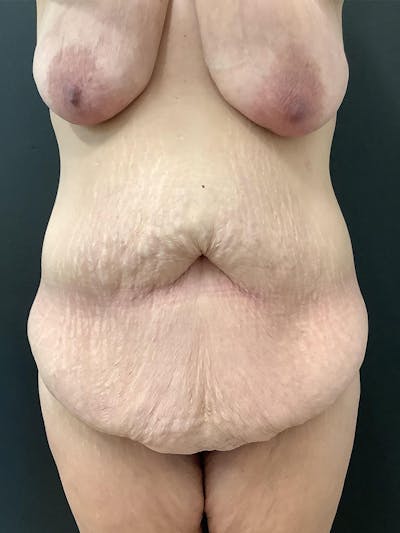 Abdominoplasty Before & After Gallery - Patient 123700573 - Image 1