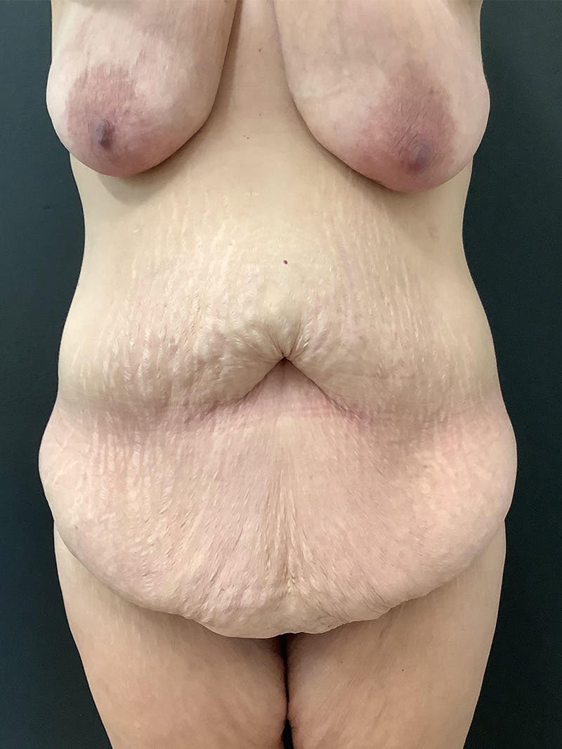 Abdominoplasty Before & After Gallery - Patient 123700573 - Image 1
