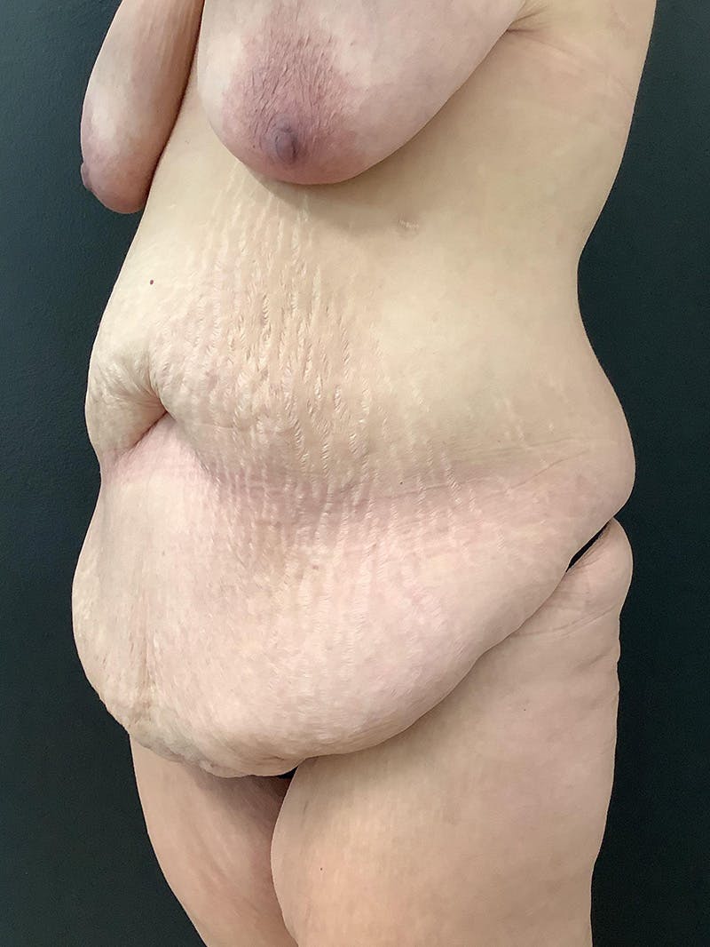 Abdominoplasty Before & After Gallery - Patient 123700573 - Image 3