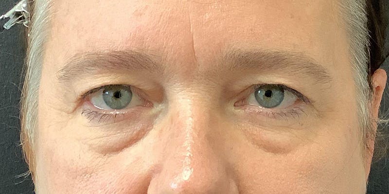 Eyelid Surgery Before & After Gallery - Patient 123701033 - Image 1