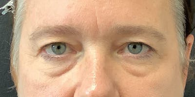 Eyelid Surgery Before & After Gallery - Patient 123701033 - Image 1