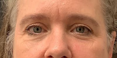 Eyelid Surgery Before & After Gallery - Patient 123701033 - Image 2
