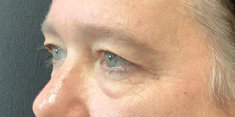 Eyelid Surgery Before & After Gallery - Patient 123701033 - Image 3