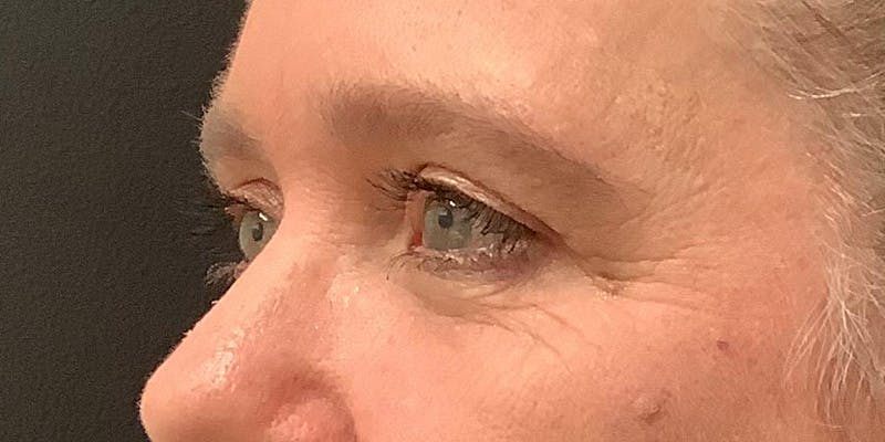 Eyelid Surgery Before & After Gallery - Patient 123701033 - Image 4