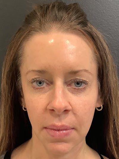 Facial Fat Transfer Before & After Gallery - Patient 123701034 - Image 2