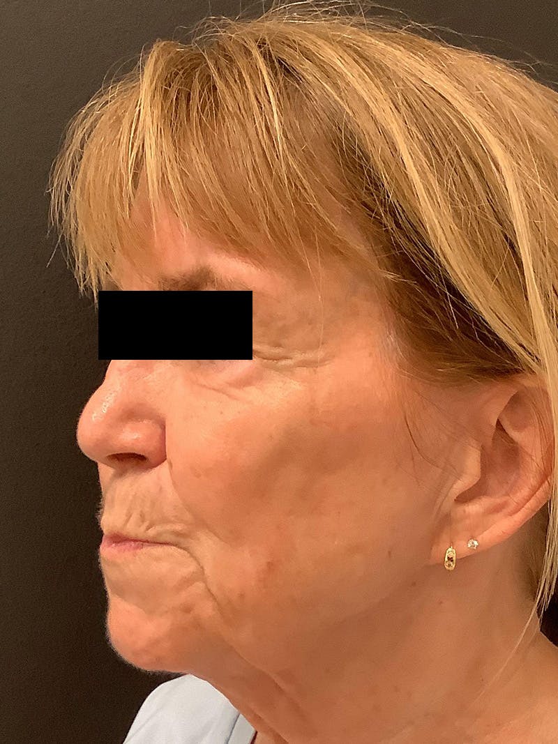 RF Microneedling Before & After Gallery - Patient 123701102 - Image 1
