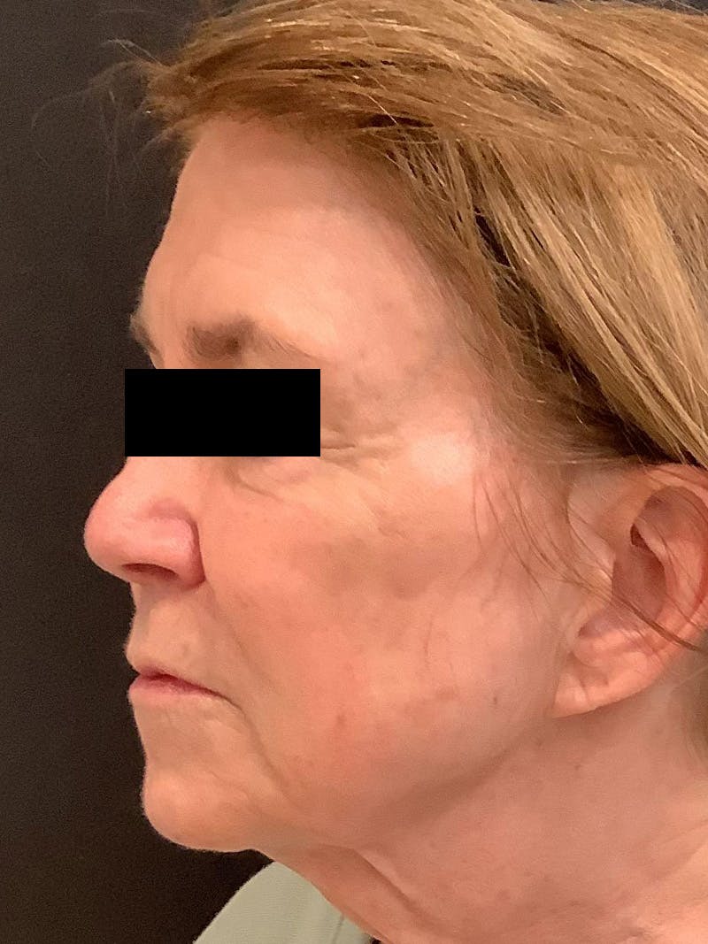 RF Microneedling Before & After Gallery - Patient 123701102 - Image 2