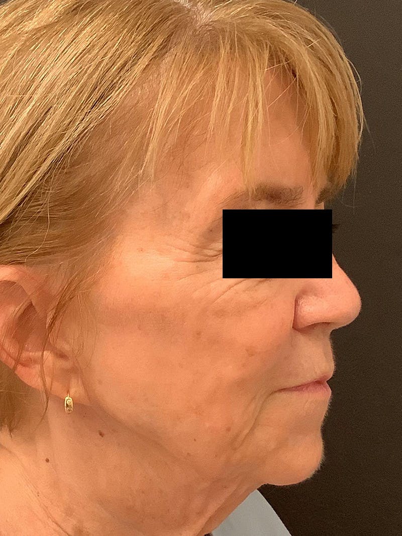 RF Microneedling Before & After Gallery - Patient 123701102 - Image 3