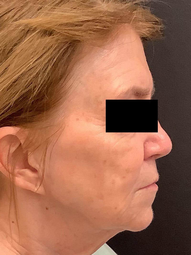 RF Microneedling Before & After Gallery - Patient 123701102 - Image 4