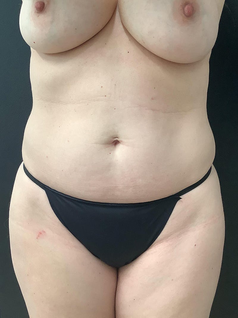 Liposuction Before & After Gallery - Patient 123717324 - Image 1
