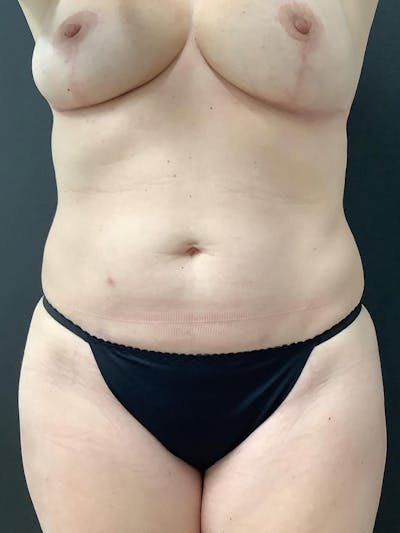 Liposuction Before & After Gallery - Patient 123717324 - Image 2