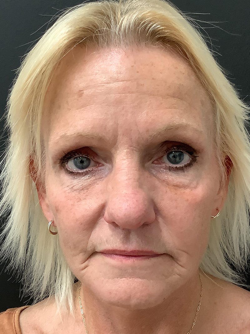 Facial Fat Transfer Before & After Gallery - Patient 123717693 - Image 4