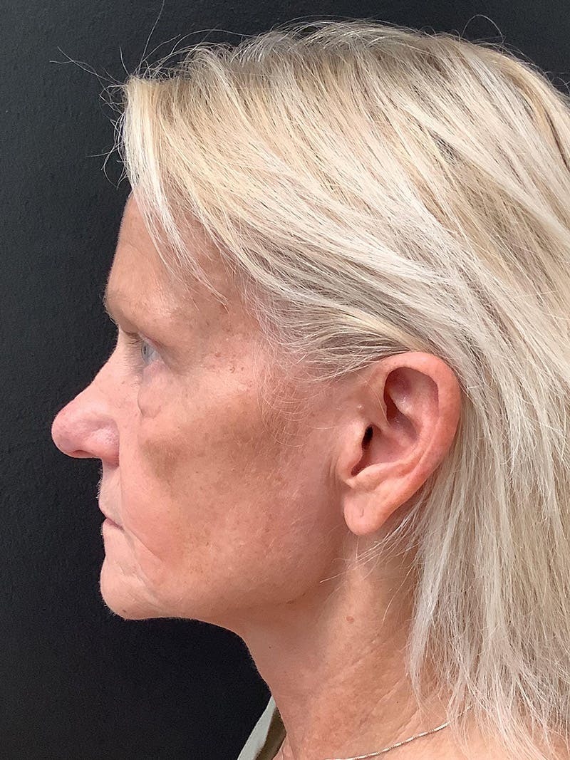 Facial Fat Transfer Before & After Gallery - Patient 123717693 - Image 1