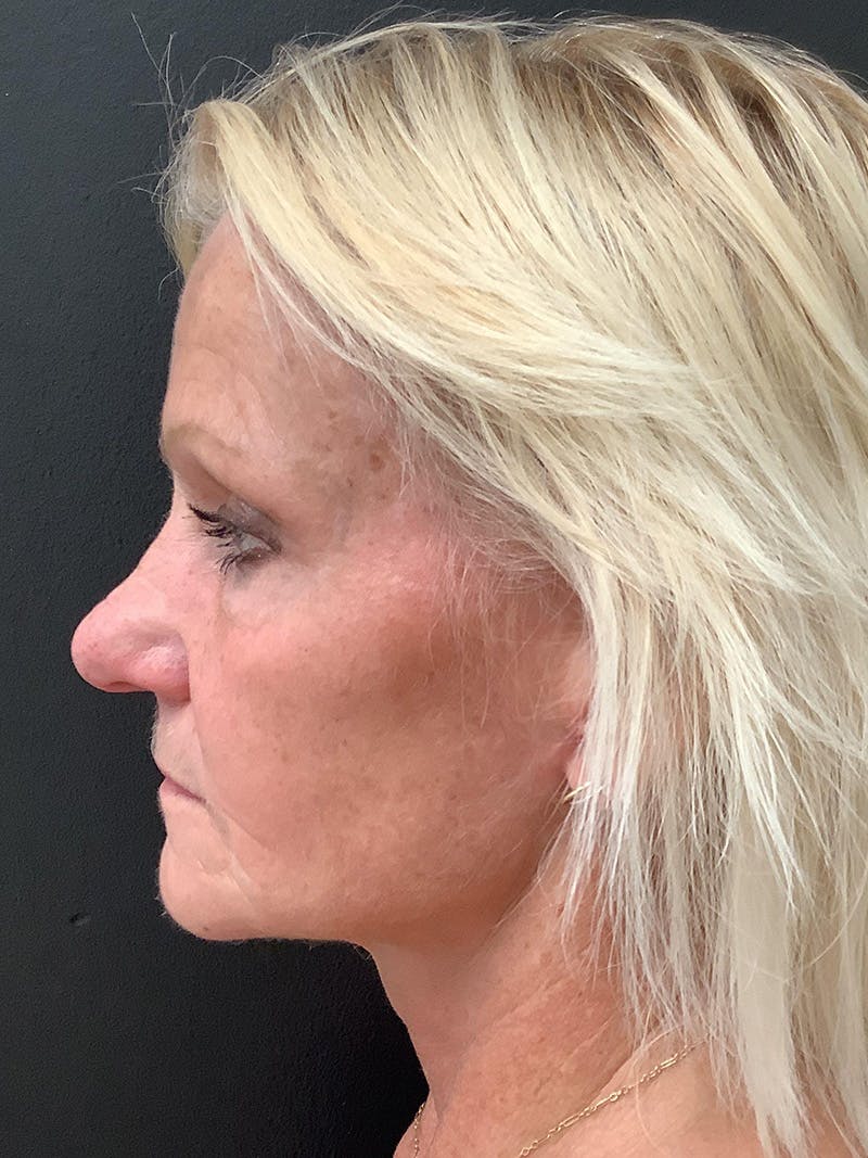 Facelift Before & After Gallery - Patient 123717692 - Image 4