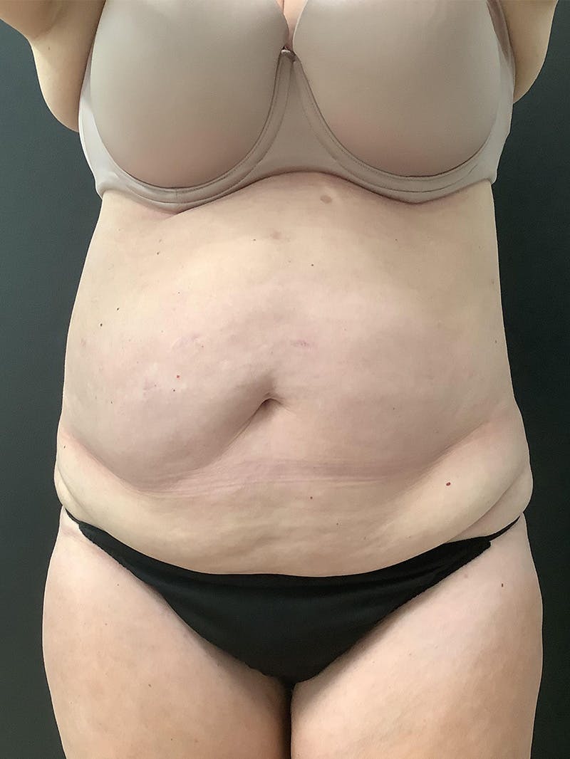 Liposuction Before & After Gallery - Patient 123717733 - Image 1